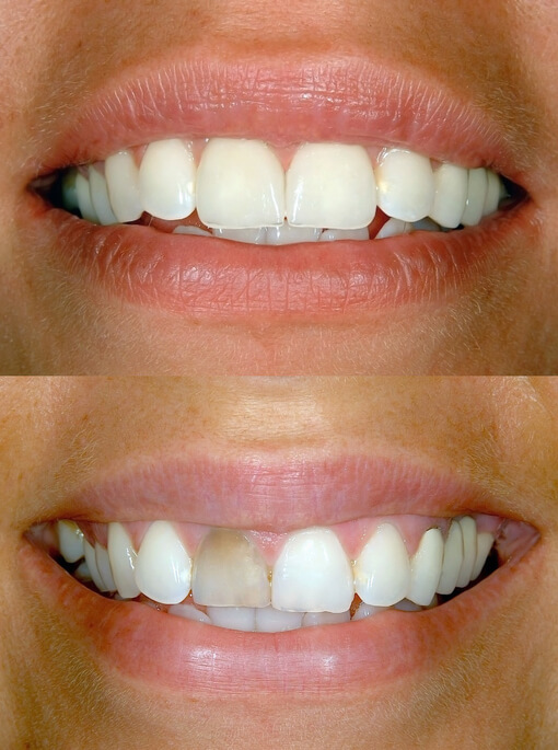 Dental veneers can dramatically improve your smile