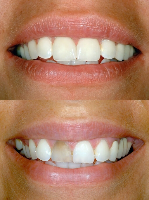 veneers