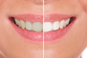 Teeth whitening makes a difference